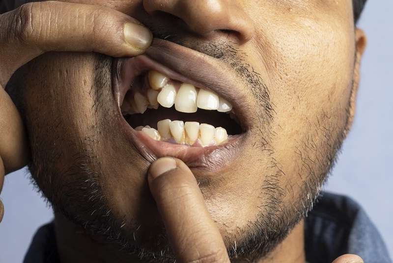 Zahnfehlstellung Hyperdontie zu viele Zähne too much teeth
