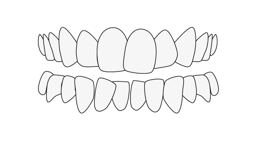 Zahnfehlstellung Engstand