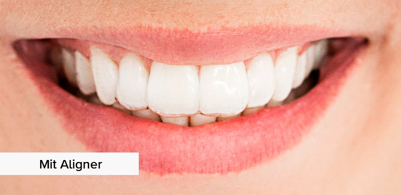 Mund mit Zahnschiene von DR SMILE